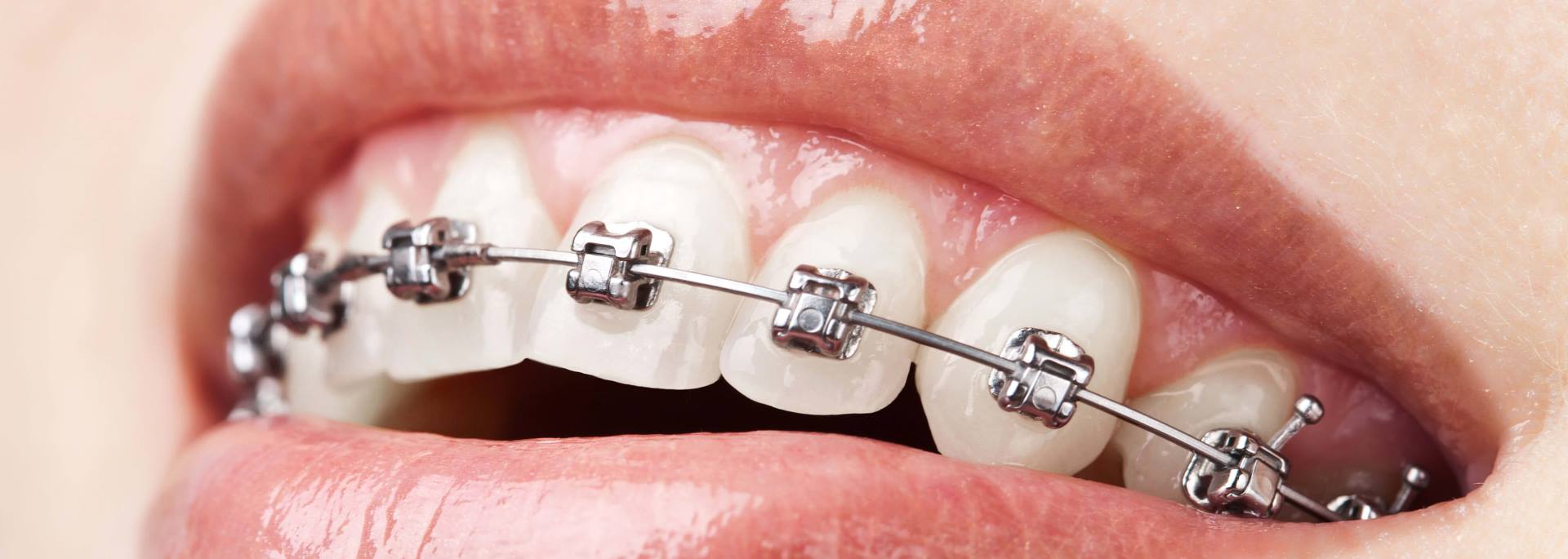 Adjunctive Orthodontic Treatments - Yang Orthodontics