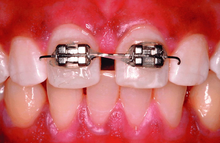 How long does orthodontic treatment take?